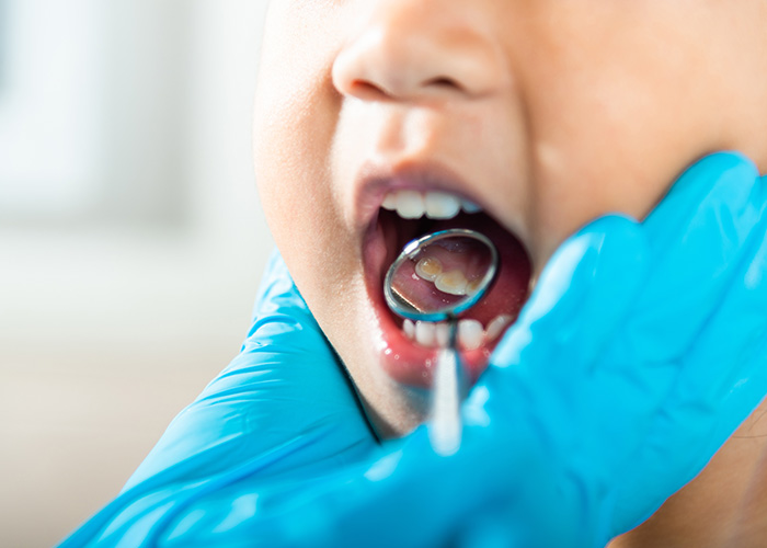 Amarillo Super Smiles For Kids | Dental Sealants, Baby Molar Crowns and Your Child s First Dental Visit