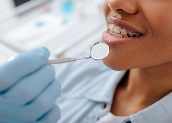 Amarillo Super Smiles For Kids | Fluoride Treatments, Baby Molar Crowns and Invisalign reg 