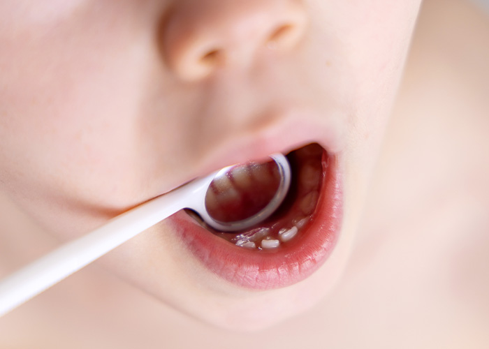 Amarillo Super Smiles For Kids | Invisalign reg , Myobrace and Cavity Treatment