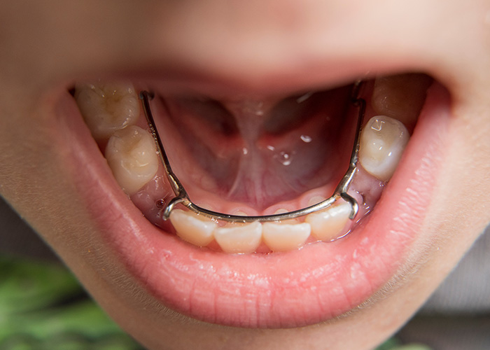 Amarillo Super Smiles For Kids | Invisalign reg , General Anesthesia and Digital X-Rays