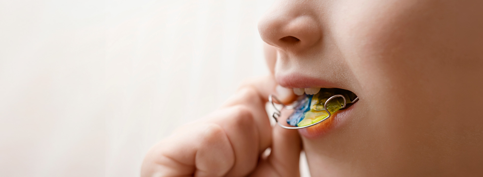 Amarillo Super Smiles For Kids | Space Maintainers, General Anesthesia and Invisalign reg